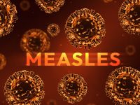 مرض الحصبة مرض الحصبة