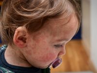 مرض الحصبة مرض الحصبة