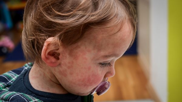 مرض الحصبة مرض الحصبة